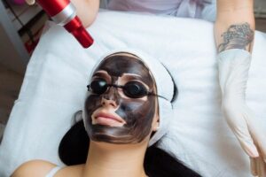 carbon peel