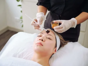 lactic Acid Peel