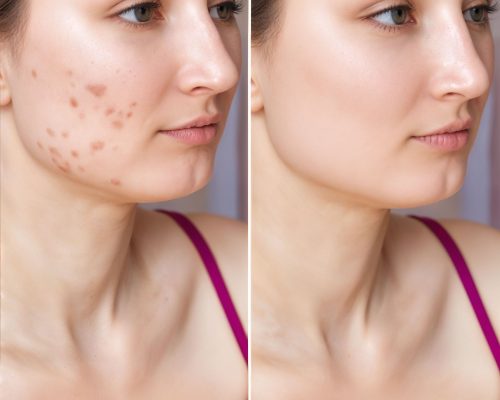 Acne-Management-Treatments